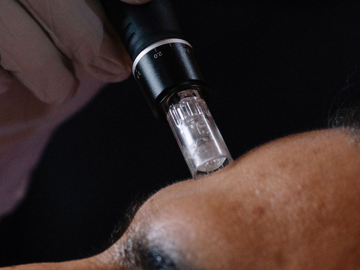 Un stylo de microneedling en cours d'utilisation sur le visage