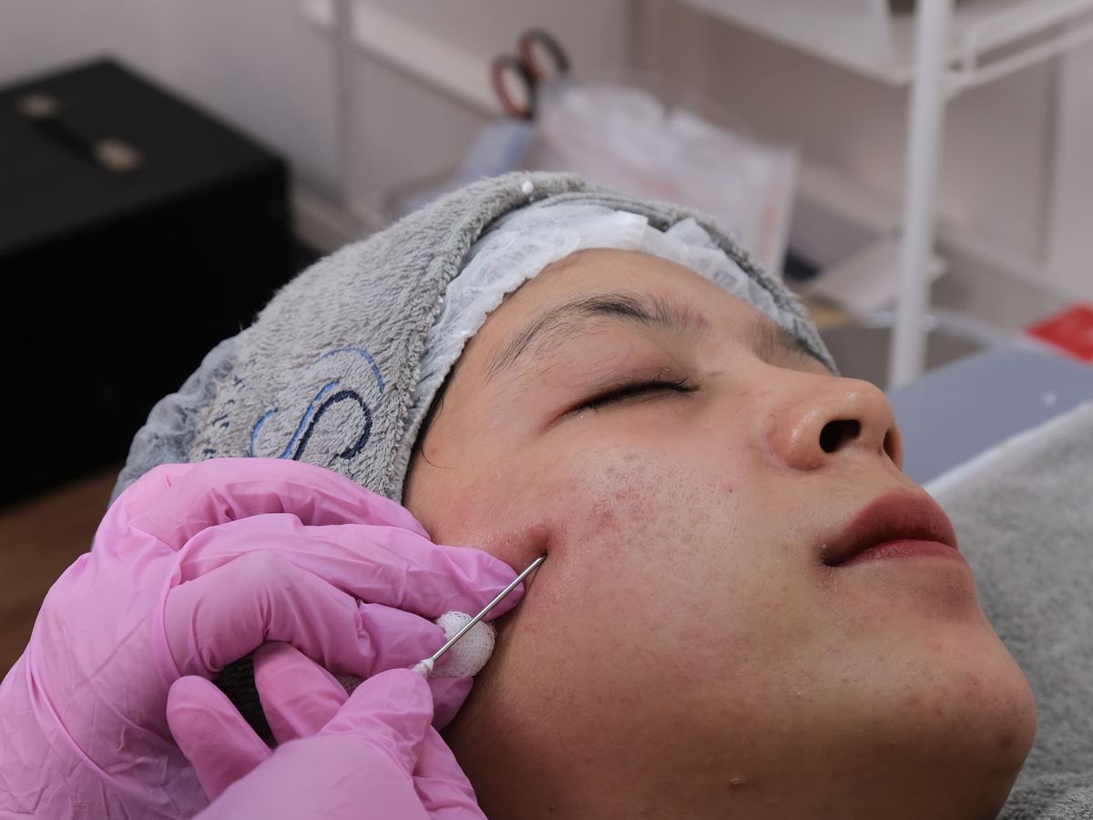 Un soin de microneedling du visage réalisé au stylo, en cabine de soin